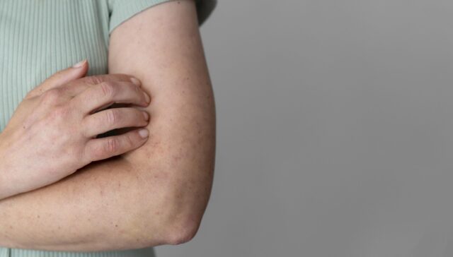 Allergic Cough