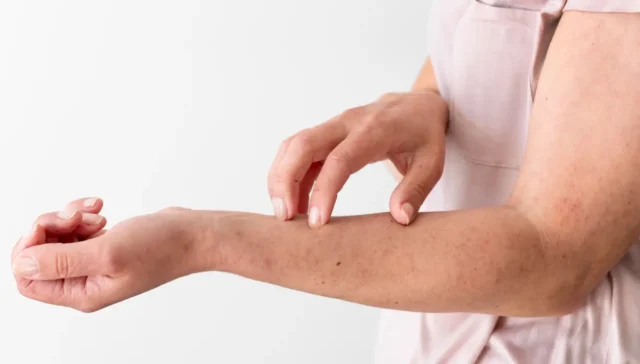 Eczema